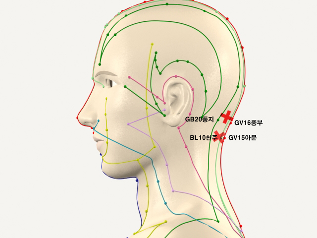 ������������_��� 통증유발점