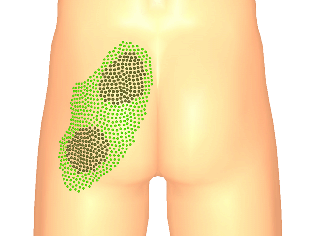 요추능형근(심층)_좌