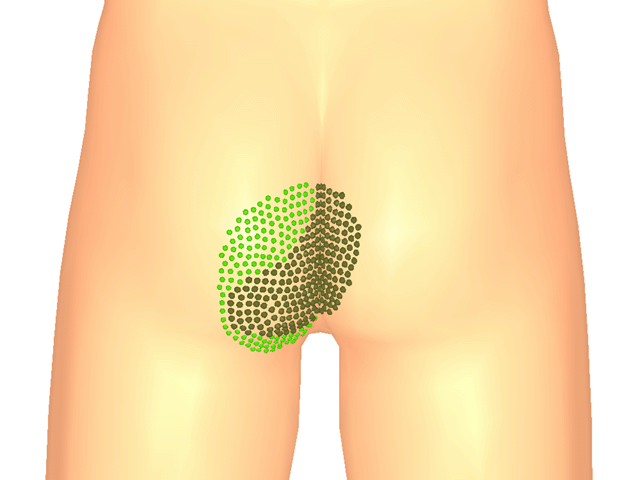 대둔근(방아쇠점3)_좌
