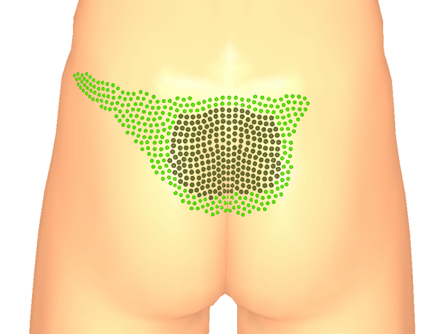 중둔근(방아쇠점3)_좌