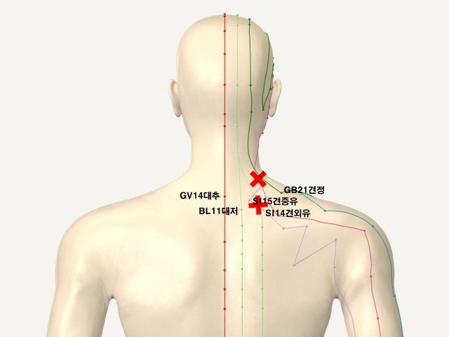 ������������_��� 통증유발점