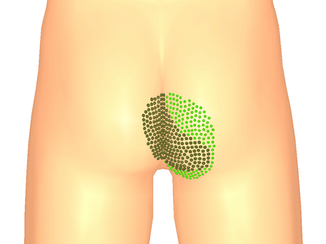 대둔근(방아쇠점3)_우