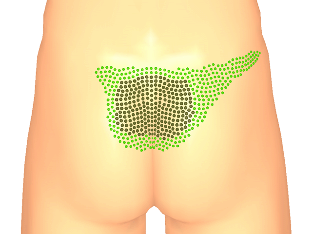중둔근(방아쇠점3)_우