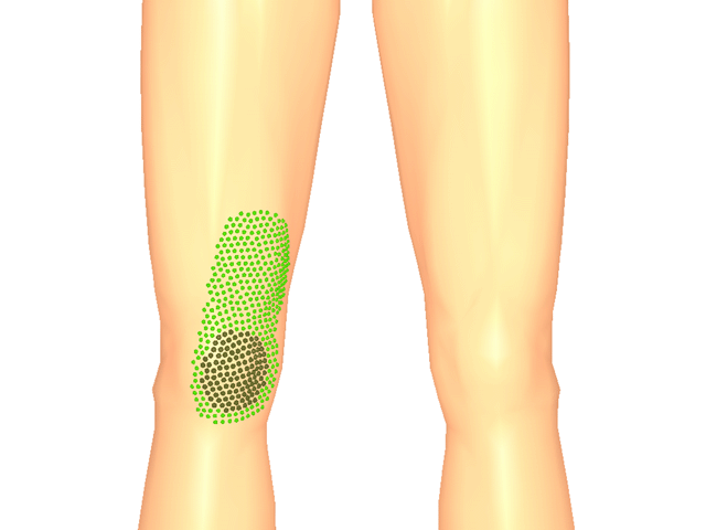 내측광근(방아쇠점1)_우