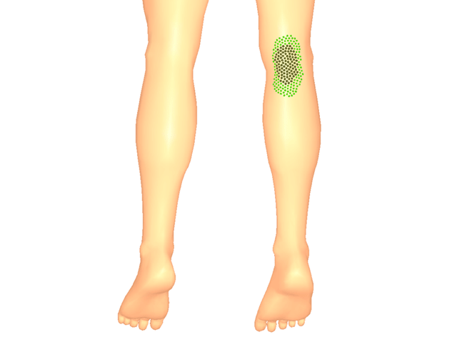 비복근(방아쇠점3)_우