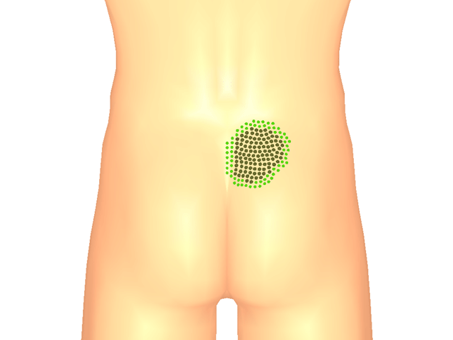 가자미근(방아쇠점3)_우